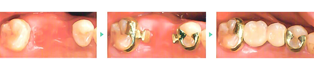 奥歯２本のヒューマンブリッジ治療例