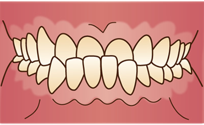 反対咬合（受け口）