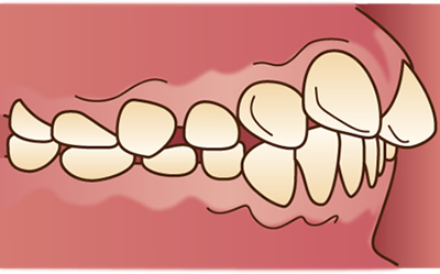 上顎前突（出っ歯）