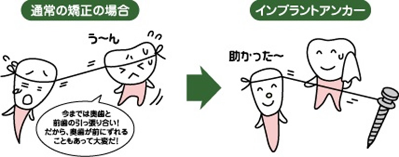 通常の矯正とインプラント矯正の比較