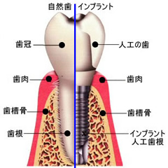 インプラント治療