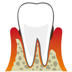 歯周病治療と予防